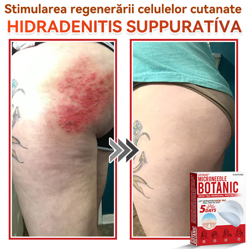 ⏰🔥✅ GFOUK® Plasture botanic cu microace pentru îndepărtarea verucilor și a negilor