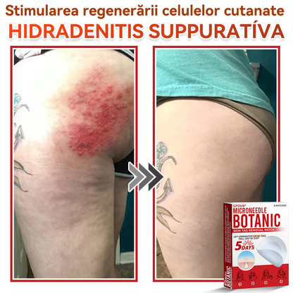 ⏰🔥✅ GFOUK® Plasture botanic cu microace pentru îndepărtarea verucilor și a negilor