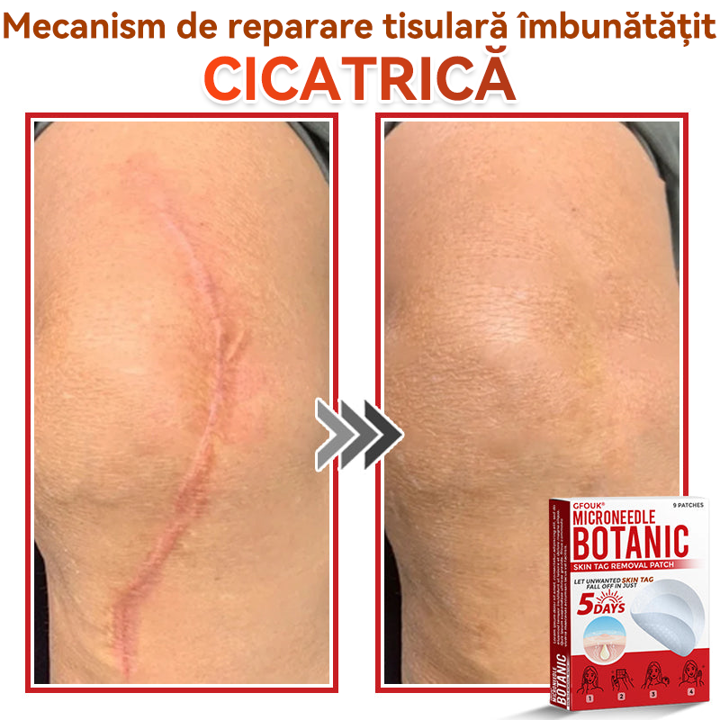 ⏰🔥✅ GFOUK® Plasture botanic cu microace pentru îndepărtarea verucilor și a negilor
