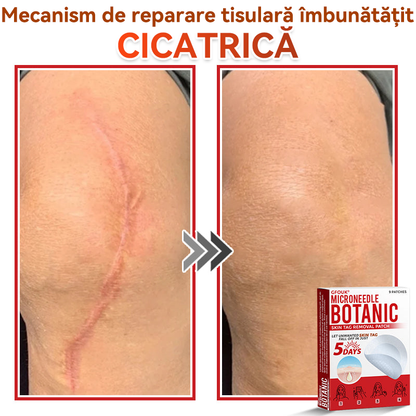 ⏰🔥✅ GFOUK® Plasture botanic cu microace pentru îndepărtarea verucilor și a negilor