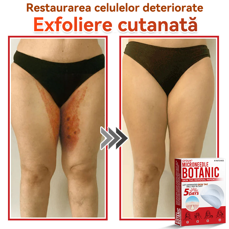 ⏰🔥✅ GFOUK® Plasture botanic cu microace pentru îndepărtarea verucilor și a negilor