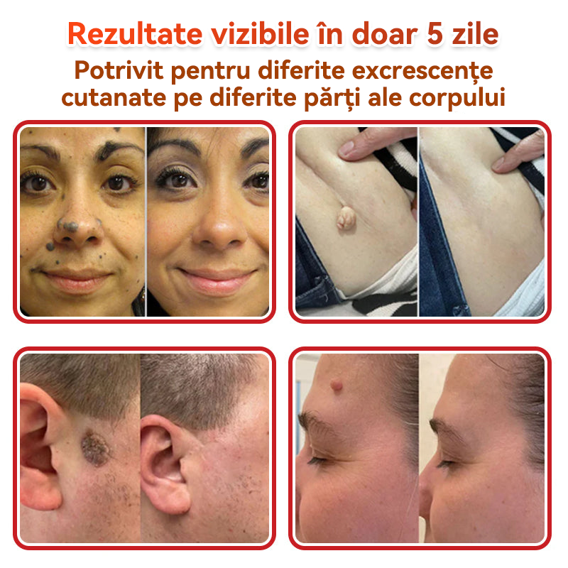⏰🔥✅ GFOUK® Plasture botanic cu microace pentru îndepărtarea verucilor și a negilor
