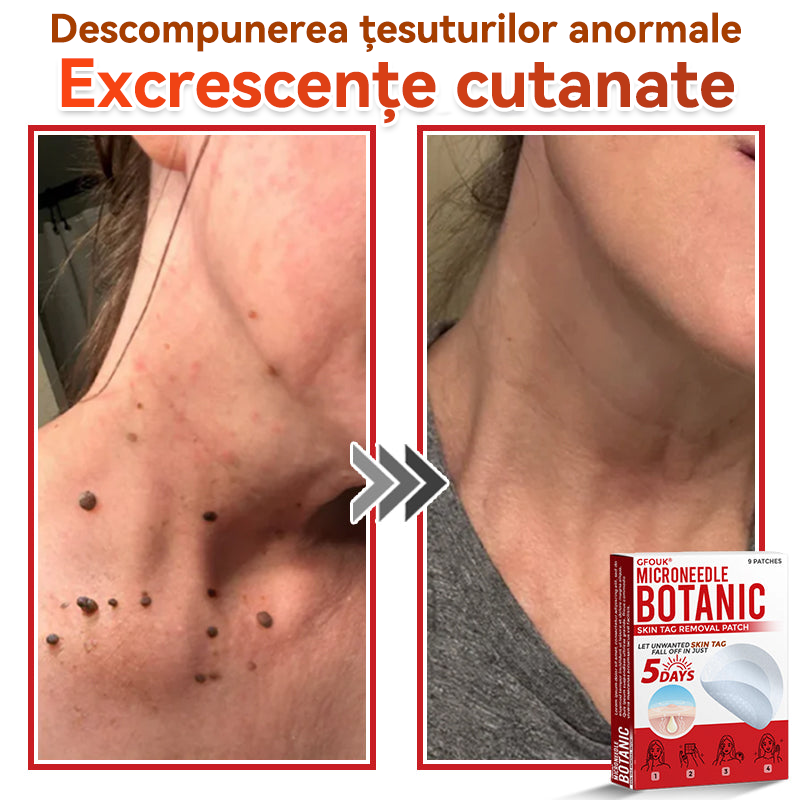 ⏰🔥✅ GFOUK® Plasture botanic cu microace pentru îndepărtarea verucilor și a negilor