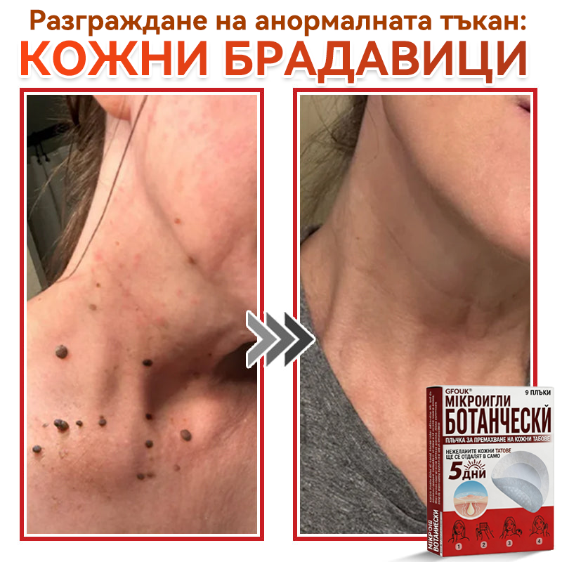 🎁 Остават само 5 опаковки! Сега можете да получите допълнителна ОТСТЪПКА от 50%!🗽✅ GFOUK® Ботаничен пластир с микроигли за премахване на кожни образувания