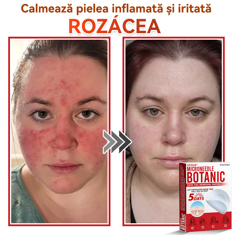 ⏰🔥✅ GFOUK® Plasture botanic cu microace pentru îndepărtarea verucilor și a negilor