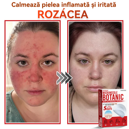 ⏰🔥✅ GFOUK® Plasture botanic cu microace pentru îndepărtarea verucilor și a negilor