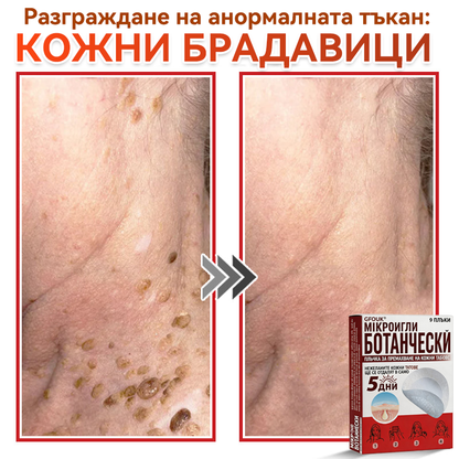 🎁 Остават само 5 опаковки! Сега можете да получите допълнителна ОТСТЪПКА от 50%!🗽✅ GFOUK® Ботаничен пластир с микроигли за премахване на кожни образувания