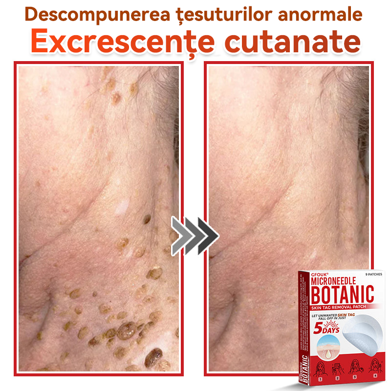 ⏰🔥✅ GFOUK® Plasture botanic cu microace pentru îndepărtarea verucilor și a negilor